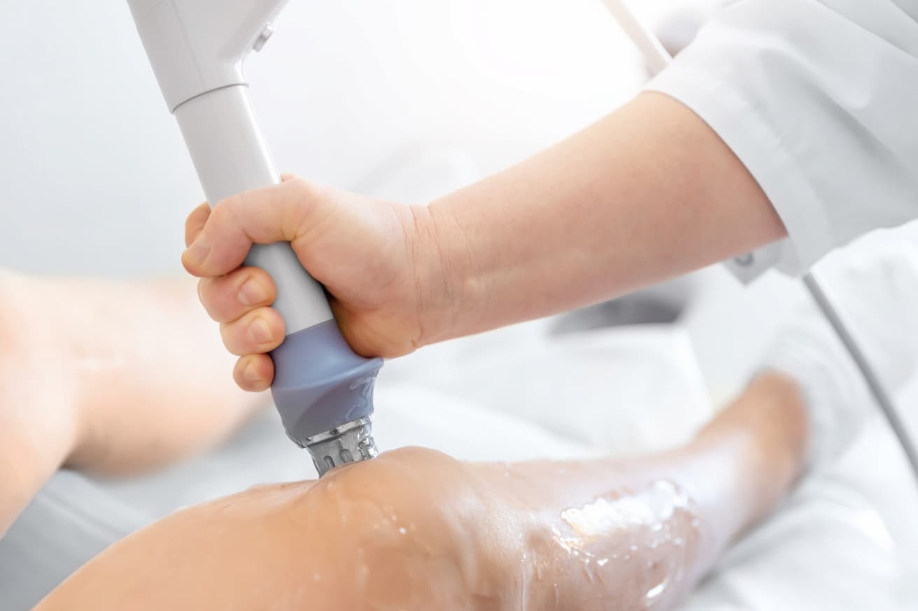cryotherapy